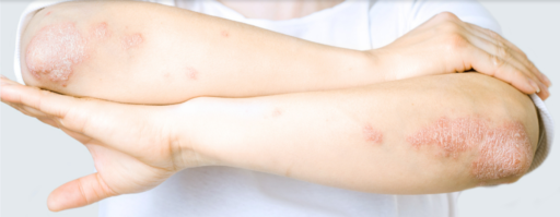 Psoriaza (luskavica) – nastanek in zdravljenje, nega kože